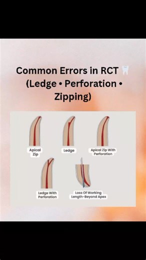 Dr priyanka on Instagram: "Errors in Root Canal Treatment (RCT) 1️⃣ Ledge Formation: • It is a deviation created on the root canal wall that stops further instrumentation to the apex. • Common in curved canals. • Cause: Use of large or straight files, inadequate glide path. • Prevention: Always pre-curve stainless-steel files, use NiTi rotary systems in curved canals. 2️⃣ Perforation: • Unwanted communication between root canal and surrounding tissues. • Types: coronal (during access), mid-root 