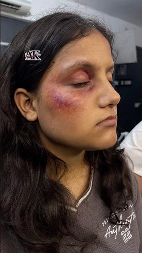 Realistic Bruise Makeup | SFX Practice (Hand ➝ Model)