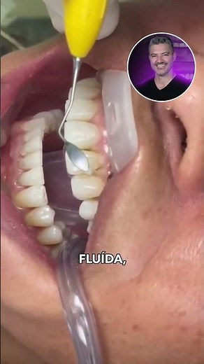 Post-Orthopedic Diastema Closure: Polyester Strip + Transcend Resin - No Complications