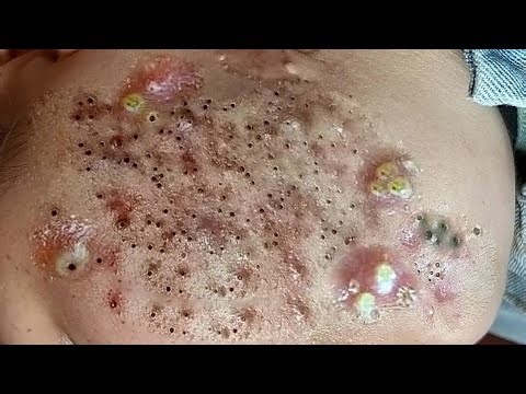 This Cyst EXPLODED on Camera — UNCUT Footage!