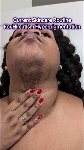 Skincare Routine for PCOS Hirsutism Dark Spots