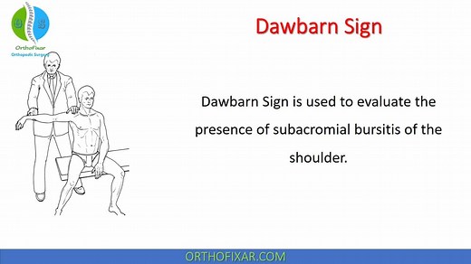 Dawbarn Sign For Subacromial Bursitis Explained Easily | OrthoFixar