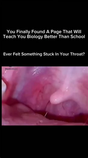 Medical Student on Instagram: "Tonsil stones (tonsilloliths) form when debris-like food particles, mucus, dead cells, and bacteria-gets trapped in the small pockets of your tonsils. Over time, this buildup hardens into tiny, white or yellow, pebble-like stones. Why they happen: Deep tonsil crypts (small pockets) Post-nasal drip. Chronic inflammation. Poor oral hygiene. Large tonsils ++ Common symptoms: Bad breath (the most common sign) White/yellow bumps on tonsils Metallic taste. Sore throat or