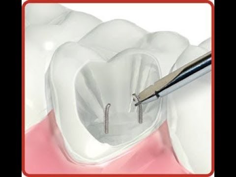 Amalgam Pins In Dentistry : A Seminar