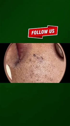 Effective Pore Extraction Techniques for Clear Skin