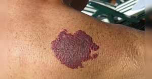 Birthmark Indications: शरीर के अंगों पर मौजूद बर्थमार्क देते हैं अलग संकेत, जानें क्या है इनका मतलब