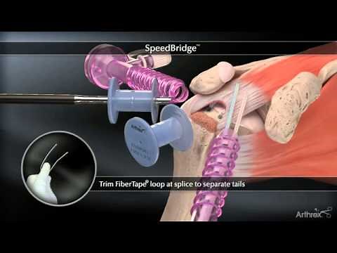 Arthrex SpeedBridge™