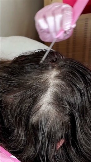 ASMR Doctor LICE Check on Scalp and Neck | Lice Removal with Tweezers #short #asmr #shorts