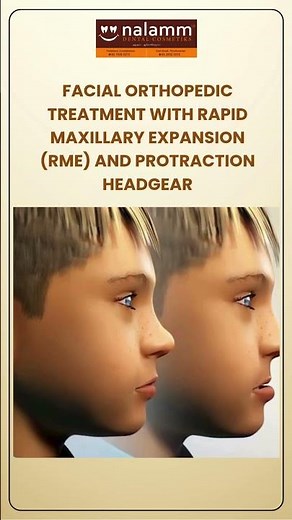 Maxillary Expansion & Face Mask Therapy | Class III Orthodontic Treatment for Kids
