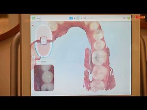 Orthodontic Records: Itero Scanning for Invisalign Orthodontic Treatment