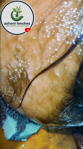 Shirodhara Treatment Benefits | Ayurvedic Therapy for Stress & Migraine
