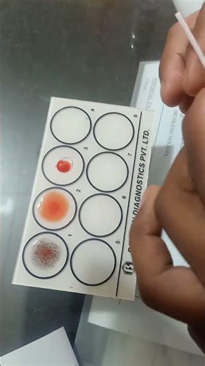 blood group # lab #