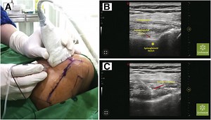 Ultrasound-Guided Suprascapular Nerve Block at Spinoglenoid Notch and Glenohumeral Joint Hydrodilation