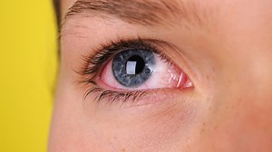Red eyes may be telltale sign you've got coronavirus, nurse warns