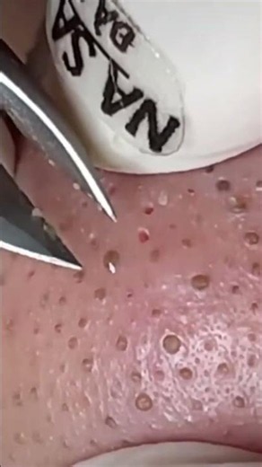 Popping huge blackheads and Pimple Popping - So Satisfying It Hurts 😮‍💨