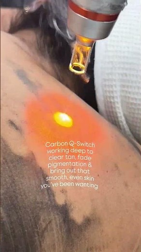Body Pigmentation Removal with Carbon Q-Switch Laser | Real Results