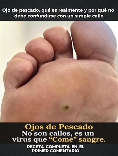 Ojo de pescado: qué es realmente y por qué no debe confundirse con un simple callo | Hazlo en 30 segundos
