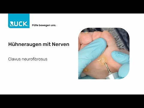 Behandlung von Hühneraugen mit Nerven: Die Top Tipps