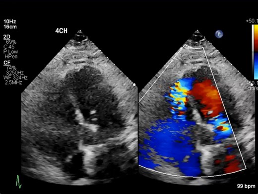 American Society of Echocardiography | What do you see in this #echofirst video? 🫀 After giving your answer, find out in our CASE report using the #LinkinBio! #ASEEchoChallenge | Instagram