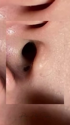 Giant Blackhead Removal from inside ear #pimple #blackhead #pimplepoppersatisfying