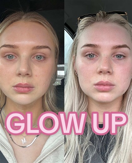 Masseter Botox and Weight Loss Transform Your Look