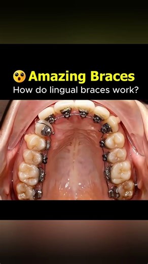 Invisible Braces Behind Teeth – Lingual Braces Full Explanation #shorts