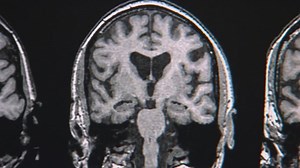 Nicotine patches could delay or prevent Alzheimer's, researchers say