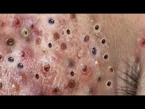 How to remove blackheads at home with a spa treatment #34