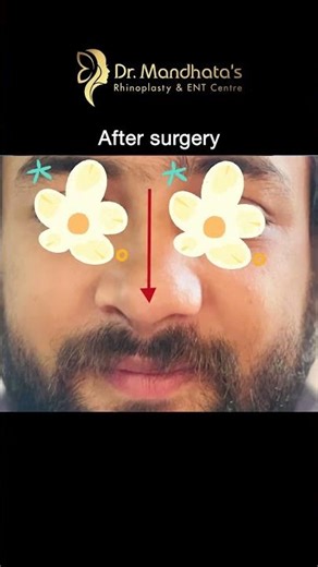 6 Months After Rhinoplasty ✨ | Before & After Results #recoveryjourney #rhinoplasty