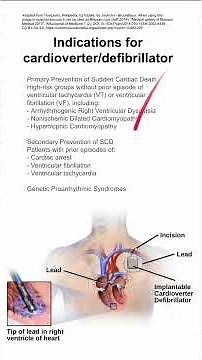 Indications for cardioverter/defibrillator
