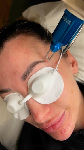 Sarah Boak PMU & Laser Clinic on Instagram: "Ever wondered how long an eyebrow laser tattoo removal patch test is? 🤷🏻‍♀️ Consultations for brow removal are 15 minutes, but within this time we will patch test your brows with the laser to see how well the pigment will lift. This will give us an idea as to whether the brow will fade nicely, go darker, go red, turn orange or yellow. Based off this we will then decide between us (depending on what the client wants) as to whether laser or saline is 