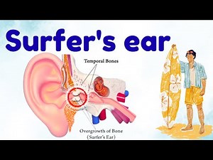 What is Surfer’s Ear? Difference between Surfer’s Ear and Swimmer’s Ear (Otitis Externa)