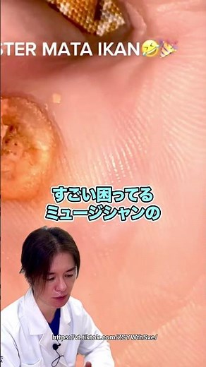 イボコロリ的なテープを貼って剥がすリアクションを見て、一発で直す方法をたかし先生が伝授！