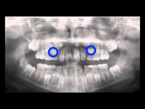 Serial Extraction Panoramic X Ray Time Lapse: Kyger Orthodontics