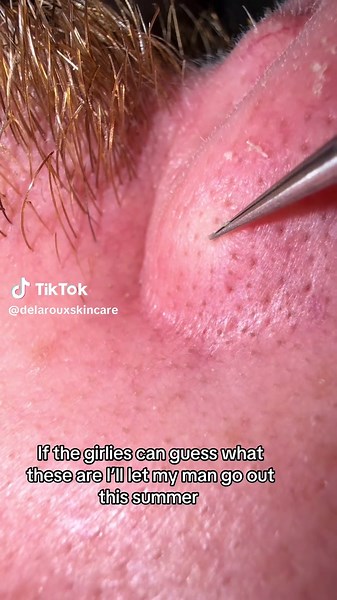 Tweezing the skin with tweezers ♥️ #skin #skincare #tweezers #pimplepopping #pimples