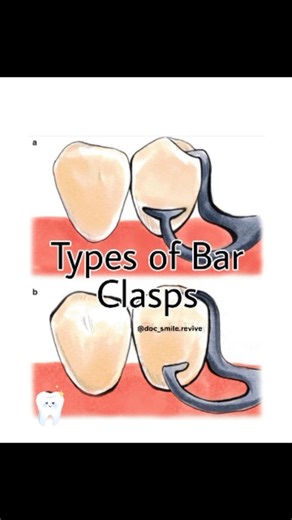 Dr priyanka on Instagram: "Bar clasps approach the undercut from the gingival direction, making them more esthetic than circumferential clasps. Remember the basics for viva: • I-bar → RPI system • T-bar → two undercuts • Modified T-bar → single undercut • Y-bar → difficult undercuts Save this before RPD exams. #Prosthodontics #RPD #BarClasp #DentalViva #bdsstudents"