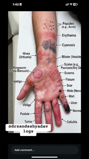 Skin infection ||type of skin infection #dermatology #icu #nailart #skincaretips #actinic #drsandesh
