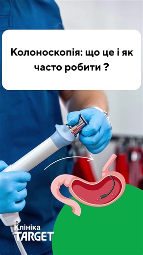 Колоноскопія: важливість ранньої діагностики