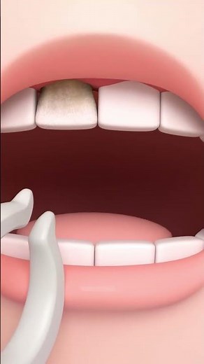 Tooth Decay Attack! Ang Ang Has a Cavity! 🦷 | Children's Dentist | #PullTooth #Shorts