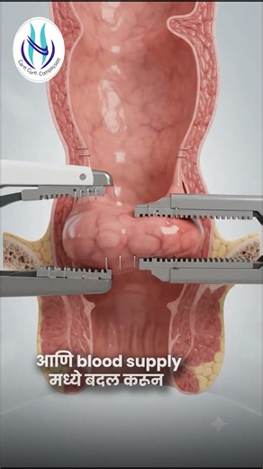 Piles Surgery Without Cutting? The Stapler Method Explained!