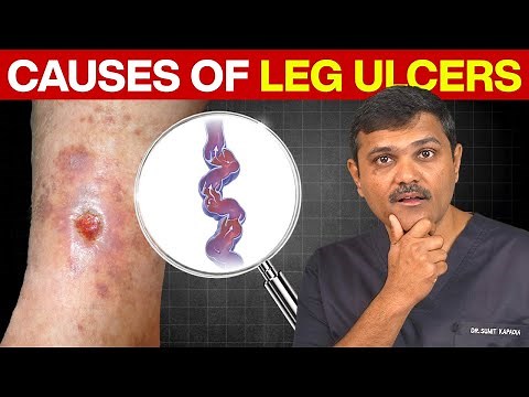 Dr. Sumit Kapadia’s Guide to Managing Leg Ulcers Effectively!