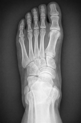 Aspectos clave en radiografía del pie para evaluación