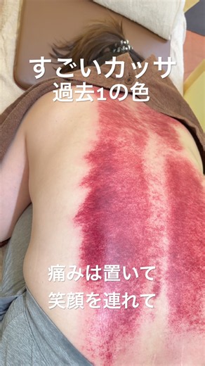 [The Worst Back Discoloration Ever‼️] Fixing a woman's chronic back strain after six months!