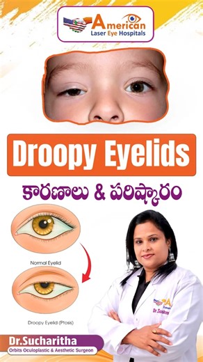 Droopy Eyelid : Causes of Drooping Eyelids | #droopyeyelids #eyelid #eyecare #healthtips #ytshorts