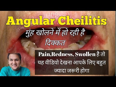 Angular Cheilitis: Cause, Symptoms, Risk Facors and Treatment