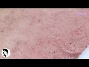 RELAXING WITH NASA SPA || SQUEEZE ACNE VIDEO #35