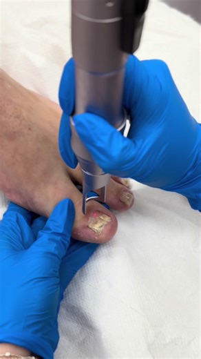 Bye-bye fungal nails 👋✨ Black Friday savings are ON! Save big on laser single sessions and courses of fungal nail treatment this BLACK FRIDAY ONLY. #fungalnail #laser #BlackFridayDeals