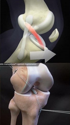 Knee Pain After ACL Surgery? Know These 3 Major Reasons!