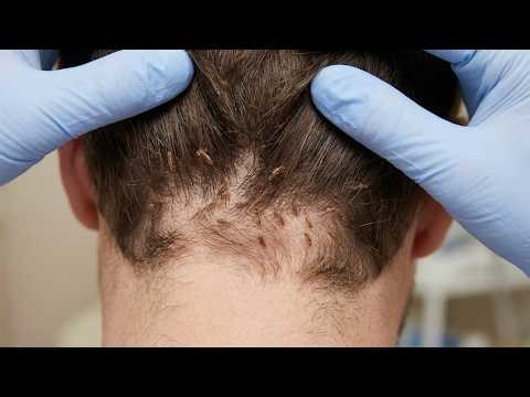 Head Lice Removal Up Close