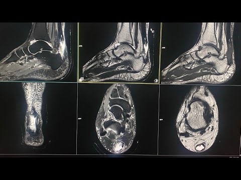 MRI ANKLE(Complete Achilles tendon tear with retraction and gapping)HMS MIRDIF PRIVATE HOSPITAL(UAE)